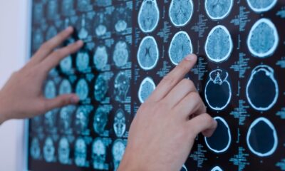 Alzheimer: cerca de la mitad de las demencias se pueden prevenir o retrasar controlando los factores de riesgo