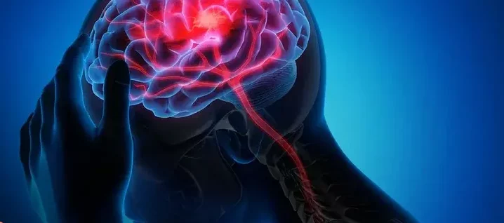 Crece el ataque cerebrovascular, especialmente en adultos jóvenes